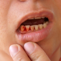 Home Remedies for Bleeding Gums You Should Try
