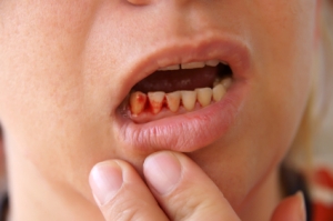 Home Remedies for Bleeding Gums